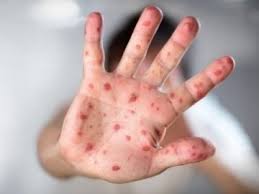 Кір не відступає. МОЗ України закликає вакцинуватися до 1 вересня